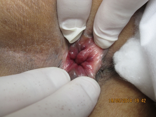 แง้มเข้าดูด้านใน พบการอักเสบของผนังทวารหนักและหลอดเลือดดำ